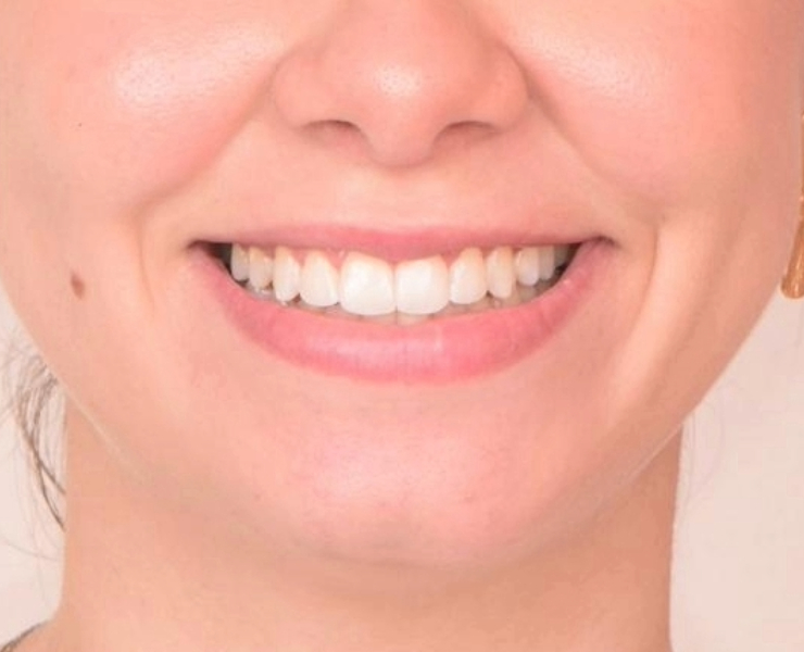 Completed smile transformation with closed gaps and aligned teeth at Orthocare Clinic.