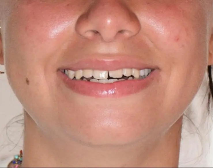 before smile makeover orthocare Teeth with gaps and uneven edges before treatment by Dr. Moussaoui B.