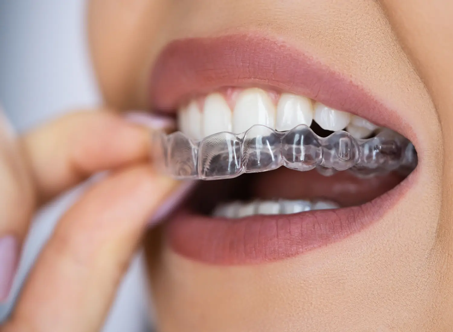 Orthodontie avancee​